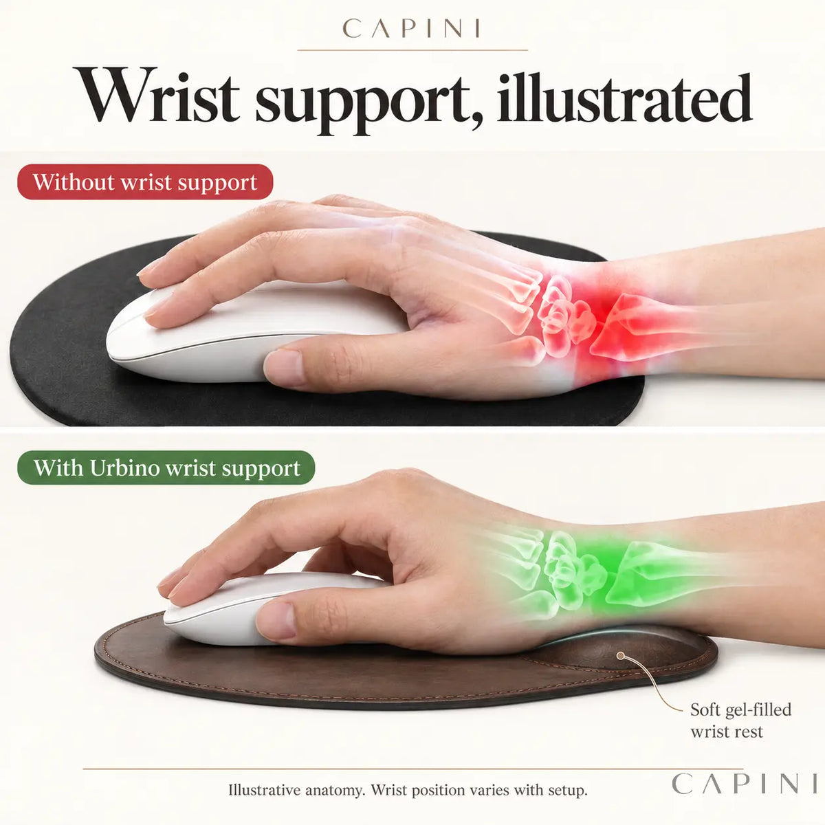 Illustrated wrist position comparison with and without Urbino gel wrist support